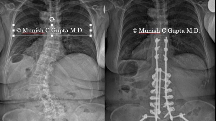 Adult Scoliosis (Lumbar) | Munish C. Gupta, M.D.